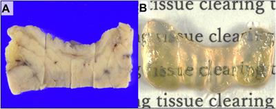 Three-dimensional analysis of perineural invasion in extrahepatic cholangiocarcinoma using tissue clearing